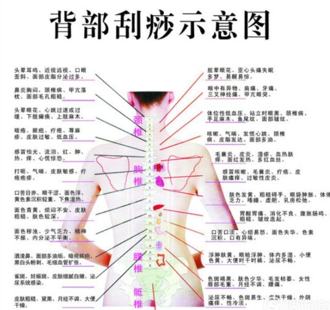 中醫背部刮痧示意圖